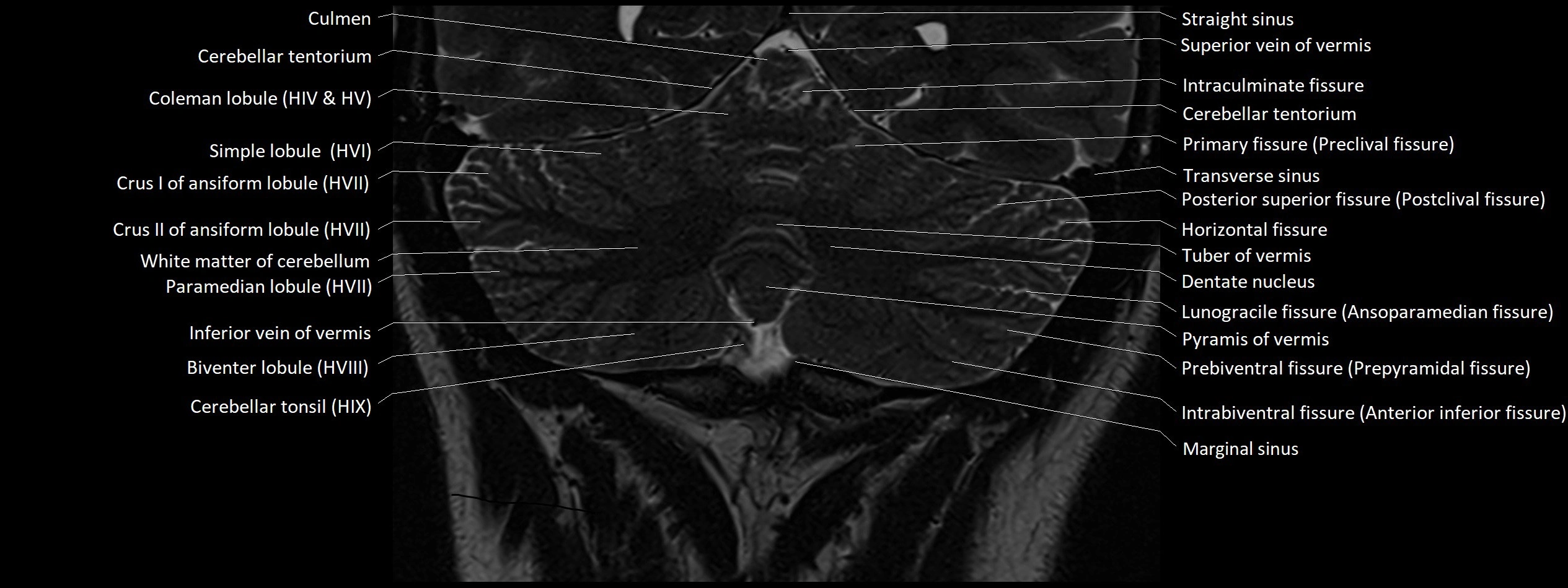 Anatomy of cerebellum coronal cross sectional 3T image 18.webp